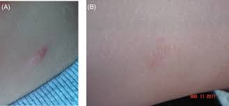 Prinzipiell können menschen jeden alters durch das. L Lysine Therapy To Control The Clinical Evolution Of Pityriasis Rosea Clinical Case Report And Literature Review Pedrazini 2021 Dermatologic Therapy Wiley Online Library