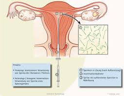 Bei zyklusstörungen oder wenn die spermienqualität des partners nicht optimal ist, empfiehlt der arzt der frau vor der intrauterinen. Behandlung Kinderlosigkeit Durch Moderne Reproduktionsmedizin Fertility Center Bayreuth