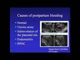 05.08.2020 · rpoc on ultrasound: Retained Products Of Conception Ultrasound Video Lecture Youtube
