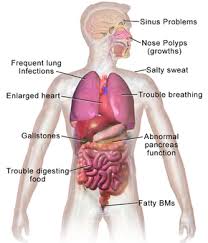 Most cf patients later develop signs of portal hypertension with complications, mainly. Cystic Fibrosis Wikipedia