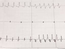 Arrhythmia Causes Symptoms Types And Treatment