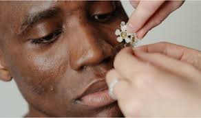 Acupuncture Melbourne