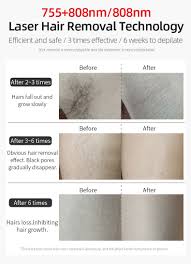 15% off tria home laser hair removal precision deluxe kit + 20% off topicals. Laser Hair Removal Machine Tria 4x Home Use 755nm 808nm Laser Hair Removal Epilator Shaving Brush Aliexpress