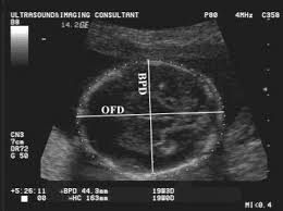 Fetal Head Measurements