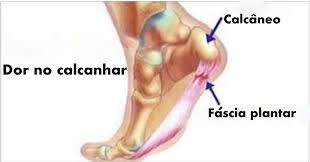Calçados Para Quem Tem Esporão E Fascite Plantar 5 Formas De Tratar A Dor No Calcanhar Naturalmente E Elimina La Para Sempre Cura Pela Natureza Dor No Calcanhar Calcanhar Dor
