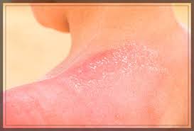 Image result for sweat rash on back