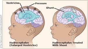 Image result for Hydrocephalus
