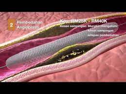 Anda boleh elakkan dari saluran jantung anda tersumbat dengan ramuan asli yang anda boleh buat doktor doktor merasa terkejut dgn keputusan semasa saluran injap saya dan memaklumkan. Bagaimana Saluran Jantung Tersumbat Cara Merawatnya Youtube