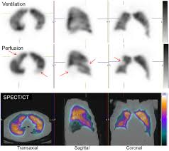 Image result for Ventilation Perfusion Scan