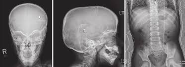 Plain X Ray Shunt Series Ap Anteroposterior A Ap Skull Xray That Download Scientific Diagram