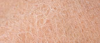 Last revised in april 2020. Kleienpilzflechte Pityriasis Versicolor Hautstadt
