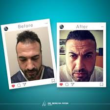 Before After Hair Transplantation Sac Ekimi Oncesi Ve Sonrasi Sacekimi Sacekimiuzmani Sacekimmerkez Best Hair Transplant Hair Transplant Before After Hair