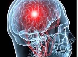 Cele ischemice sunt mai frecvent. Tehnici Si Proceduri De Recuperare DupÄ Un Accident Vascular Cerebral