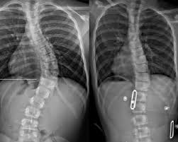 هل يُعتبر حزام اعوجاج العمود الفقري استثمارًا صحيًا طويل المدى؟