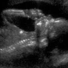 Sound waves with frequencies above the human hearing range. Anomaly Scan 20 Weeks Babycentre Uk