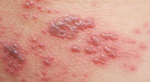 الحزام الناري حبوب تشبه الجدري. Ø¹Ù„Ø§Ø¬ Ø§Ù„Ø­Ø²Ø§Ù… Ø§Ù„Ù†Ø§Ø±ÙŠ Ù…Ø¹Ù„ÙˆÙ…Ø§Øª Ù…Ù‡Ù…Ø© ÙˆÙŠØ¨ Ø·Ø¨