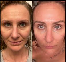 Does panoxyl help with acne and oil control?