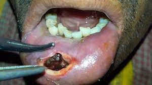 Check out the pronunciation, synonyms and grammar. Traumatic Lower Lip Myiasis A Rare Presentation Youtube