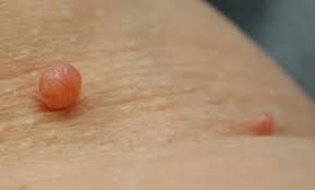 Quickly clear hemorrhoids in days. Understanding The Do S And Don Ts Of Large Skin Tag Removal