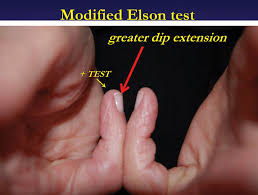 Image result for Elson Extensor Tendon Test