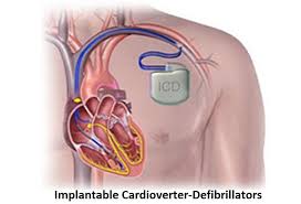 Implantable cardioverter defibrillators (icd) are devices that save the lives of patients at high risk of ventricular tachycardia or fibrillation.\na tachycardia is a very fast heartbeat of more than 100 beats per minute. Implantable Cardioverter Defibrillators Icd Market