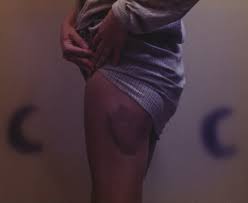 Bonnies Bruise (Later Version), Buffalo, NY • MOCA