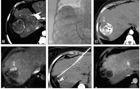 To help you prepare, here's a look at what to expect. How To Radiologically Assess And Follow Response After Treatment Of Hepatocellular Carcinoma