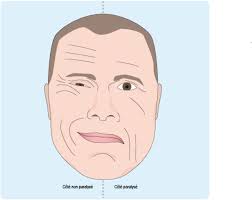J'ai voulue créer cette page pour que l'on puisse échanger sur l'hémiplégie et répondre au mieux. Symptomes Diagnostic Et Evolution De La Paralysie Faciale Ameli Fr Assure