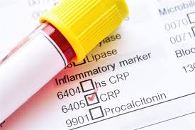 This includes reflex and additional tests. ØªØ­Ù„ÙŠÙ„ Crp Ù„Ù„Ø£Ø·ÙØ§Ù„ Ø£Ù‡Ù…ÙŠØªÙ‡ ÙˆØ·Ø±ÙŠÙ‚Ø© Ø¥Ø¬Ø±Ø§Ø¦Ù‡ ÙˆÙ…ÙˆØ¹Ø¯ Ø¸Ù‡ÙˆØ± Ø§Ù„Ù†ØªÙŠØ¬Ø© Ø§Ù„ÙƒÙˆÙ†Ø³Ù„ØªÙˆ