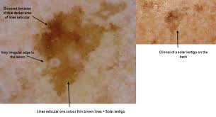 Image result for Solar Lentigo