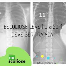 A escoliose de 3 graus é uma doença em que a radiografia mostra o ângulo da curvatura da coluna vertebral para a direita ou para a esquerda em relação ao seu eixo de 25 a 50 graus. Facebook