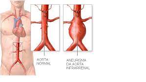Ele fora encaminhado para o hc e realizou cirurgia vascular de emergência. Aneurisma Da Aorta Abdominal Aaa Sbacv Regional Sao Paulo