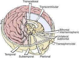 Craniopharyngioma Brain Tumor Tumor Neuro