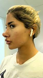 Bullying at school made me get a nose job