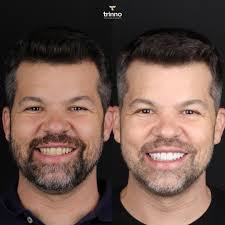 Olha só como era o sorriso do Raul e como está agora! ✨😊✨ O Raul juntou-se  ao Dr. Euriberto Santana, e após um minucioso trabalho de confecção e  planejamento, produziu esse resultado