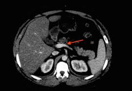 Treatment of necrotizing meningoencephalitis in dogs. Cureus Contrast Induced Thrombosis In Acute Mild Pancreatitis