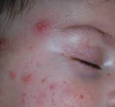 Acne is a general term used for eruptive disease of the skin. Neonatal And Infantile Acne Vulgaris An Update Mdedge Dermatology