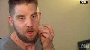 Face Transplant Recipient Mitchell Hunter Describes What It's Like To Feel  'Normal' Again Five Years After Procedure
