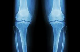 Cochrane database of systematic reviews. Osteoarthritis Innovation In Biomechanics Biology And Imaging