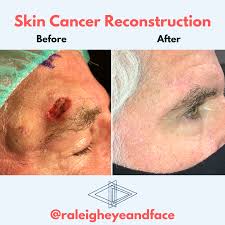Some types of skin cancer are more dangerous than others, but if you have a spot. Skin Cancer Reconstruction Raleigh Eye And Face Plastic Surgery