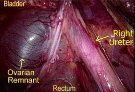 Laparoscopic Management Of Ovarian Remnant Fertility And Sterility