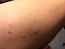 Ingrown Beard Hair Cyst
