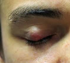 Das gerstenkorn füllt sich nach einiger zeit mit eiter. Hagelkorn Chalazion Symptome Und Behandlung