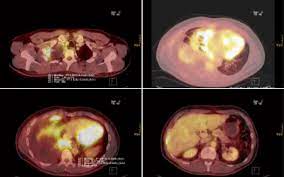 T2 or 3, n0, m0 · stage ii: Management Of Malignant Pleural Mesothelioma Part 1 Epidemiology Diagnosis And Staging Springerlink