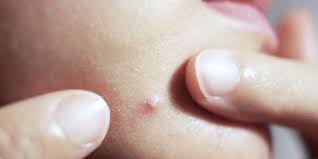 Oleskan secara langsung ke wajah sebagai pelembap. 8 Cara Menghilangkan Jerawat Dengan Cepat Secara Alami Efektif Dan Aman Dilakukan Merdeka Com