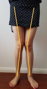 With pseudo knee locking, you can't move your knee because you are in pain. How To Fix Knee Valgus Updated 2020 Posture Direct