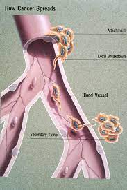 Breast cancer mostly spreads to the bones, lungs, liver, and brain. Metastasis Wikipedia