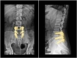 Facet Joint Replacement Onz Spine