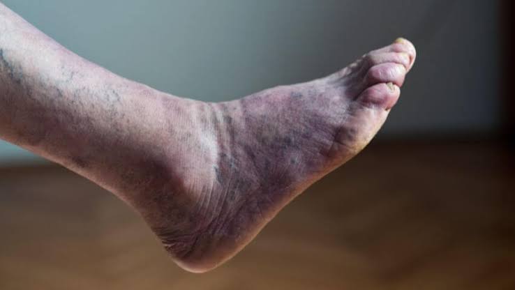 What Does Poor Circulation in Legs and Feet Look Like?