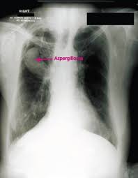 Mucormicosis pulmonar tos productiva fiebre disnea hemoptisis malestar general. Aspergilosis Infecciones Manual Msd Version Para Publico General